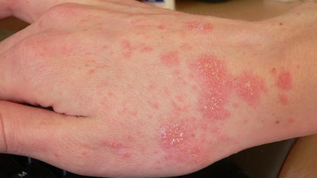 scabies
